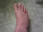 Broke my foot again 7/6/2011....